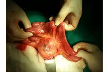 Anekoik Kistik Lezyon Tedavisi