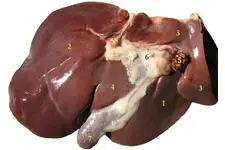 Karaciğerde Kistik Lezyon Belirtileri ve Tedavisi