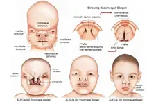 Kistik Fibrozis Nedir?