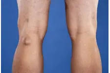 Kistik Lezyon Nedir?