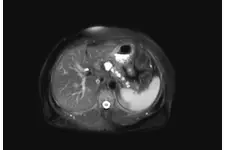 Komplike Kistik Lezyon Belirtileri ve Tedavisi