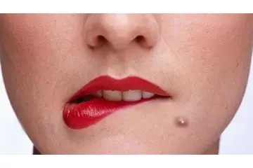 Çenede Kistik Sivilce Belirtileri ve Tedavisi