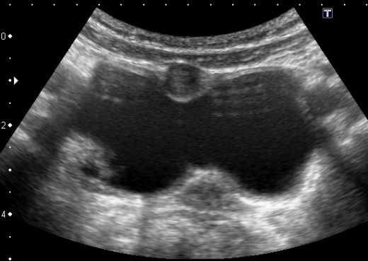 Kistik Kitle Neden Oluşur?